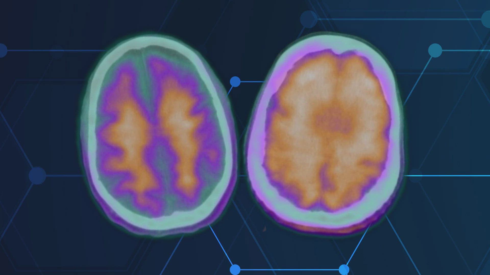 A new Alzheimer's drug, Lecanemab, targets brain plaque, showing promise in slowing cognitive decline.