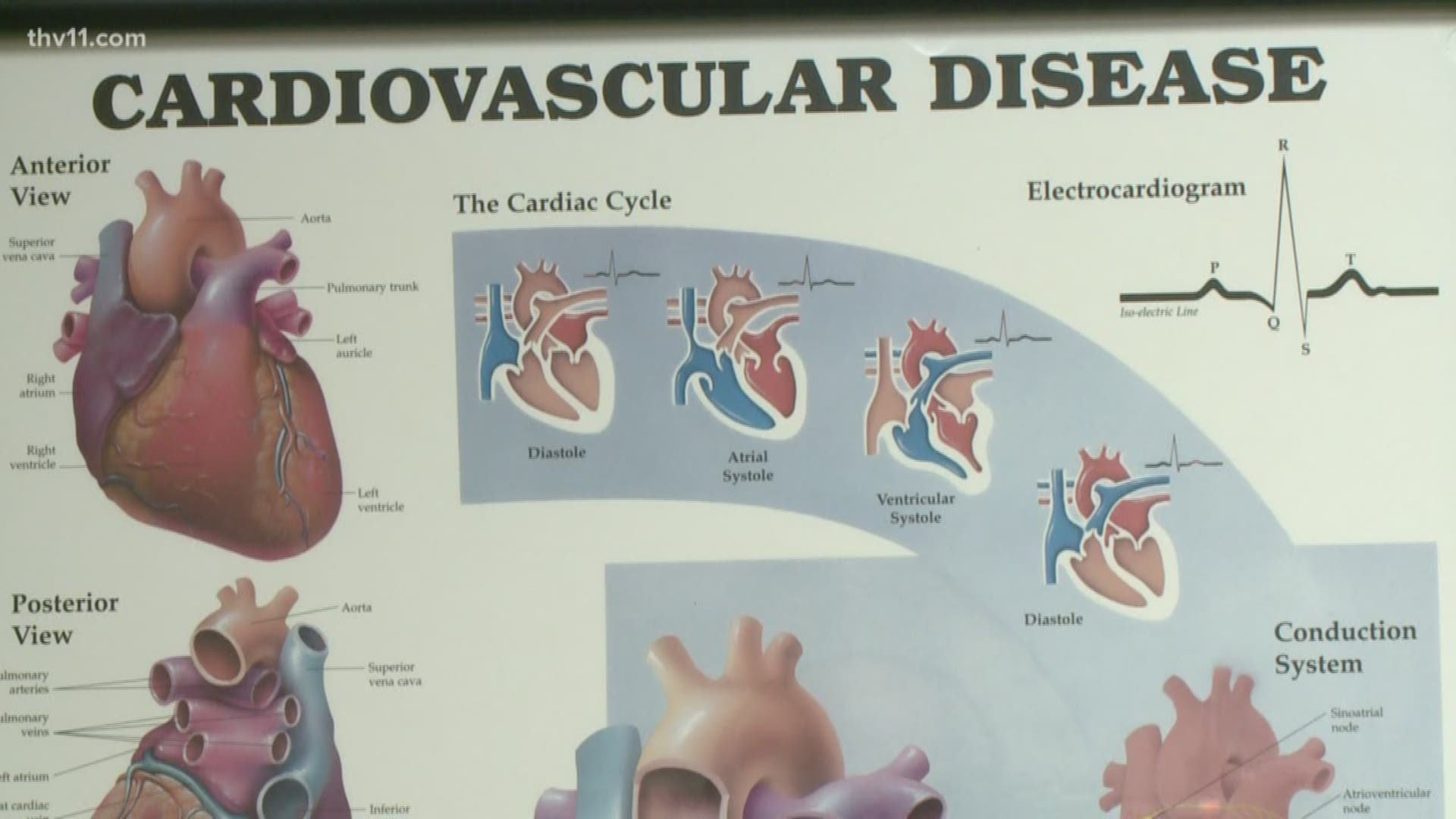 Coronary artery disease is the narrowing or blockage of the coronary arteries, usually caused by atherosclerosis.