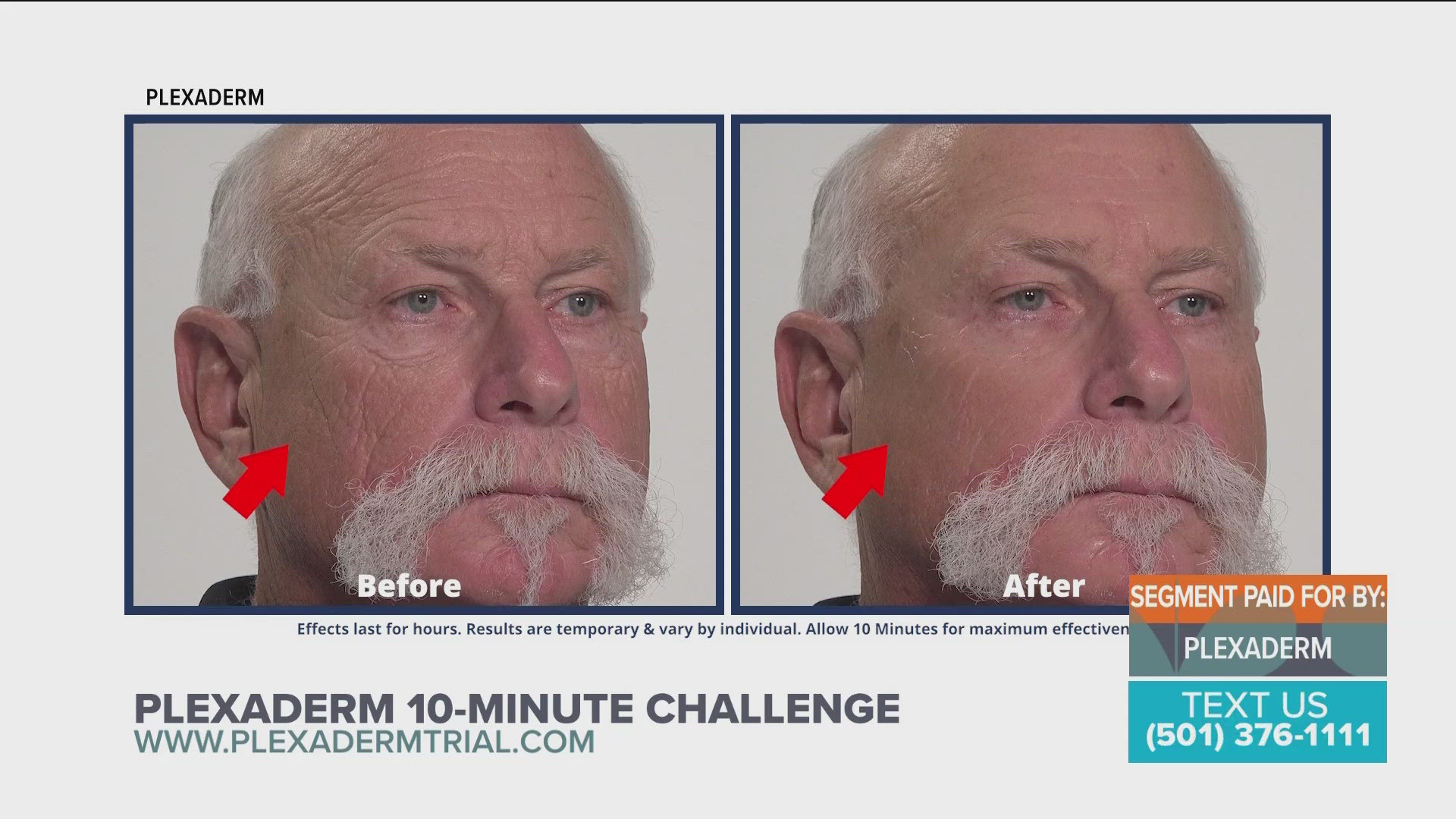 Take the Plexaderm 10-minute challenge and shrink under-eye bag and wrinkles.  A $14.95 trial pack with free shipping is available.