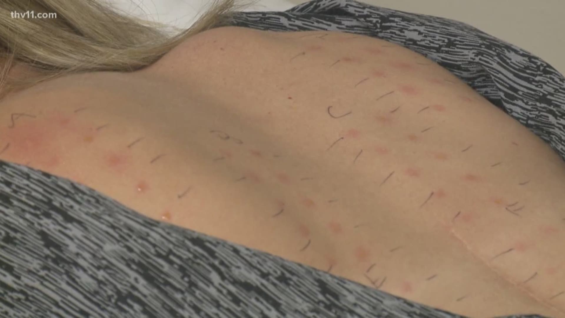 You think you're allergic after sneezing a billion times? Well, Laura and Mariel got an allergy test and the results aren't what they thought it would be.