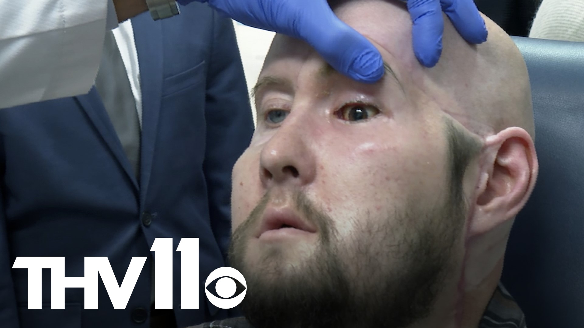 Some specialists had feared the donated eye would quickly shrivel like a raisin. Instead, months later doctors are seeing good blood flow and no sign of rejection.