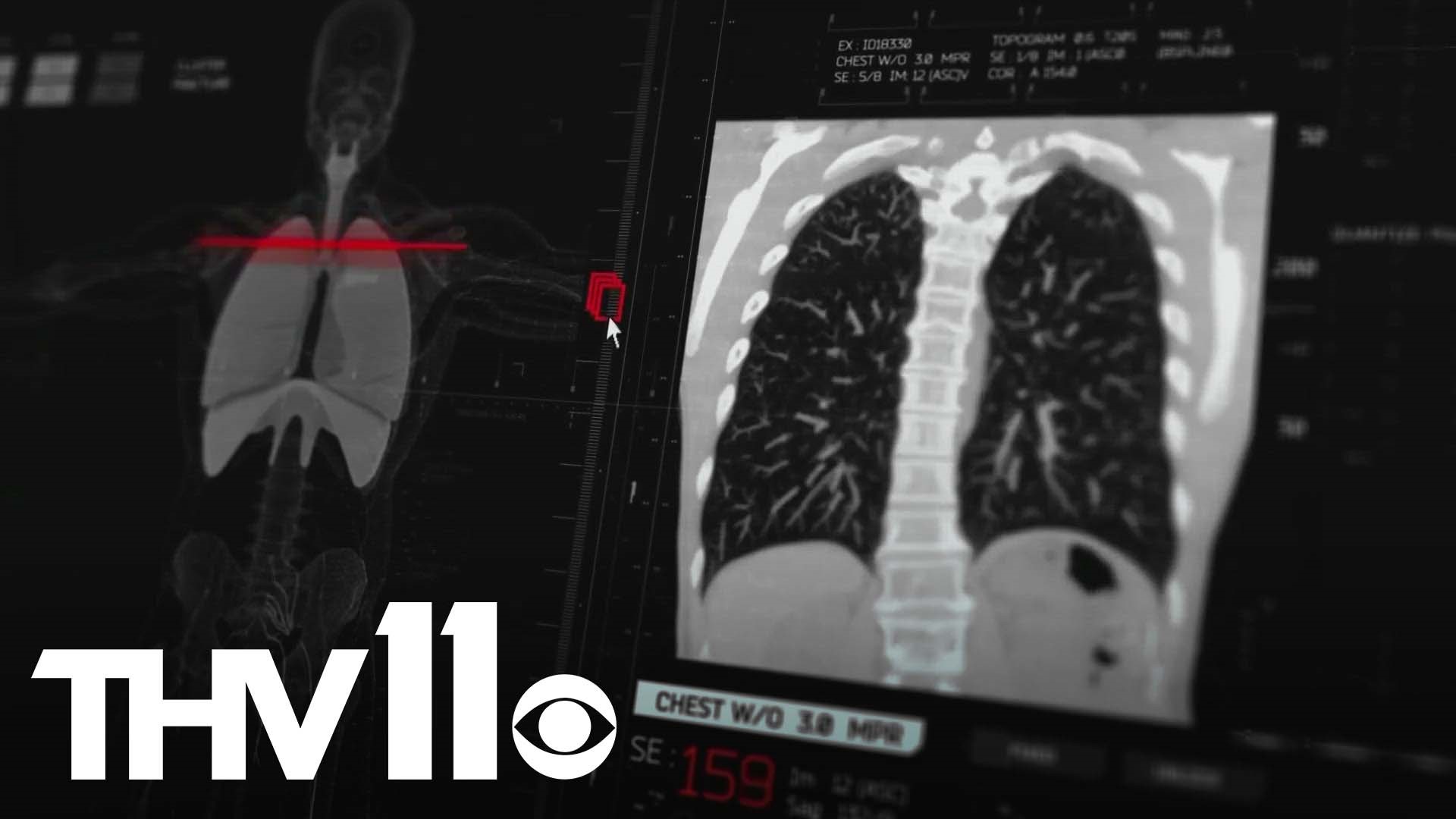A new warning from the American Cancer Society stated that more people than ever should get screened for lung cancer.