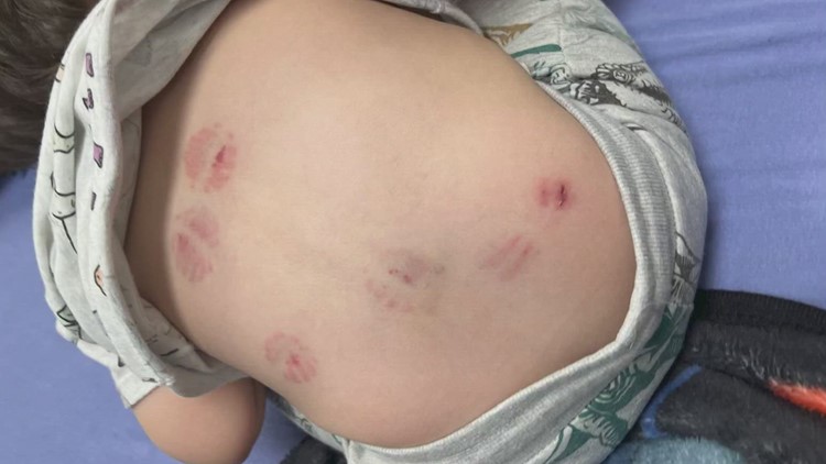 'How can you not notice eight bites?' | Family alleges toddler's injuries occurred at daycare