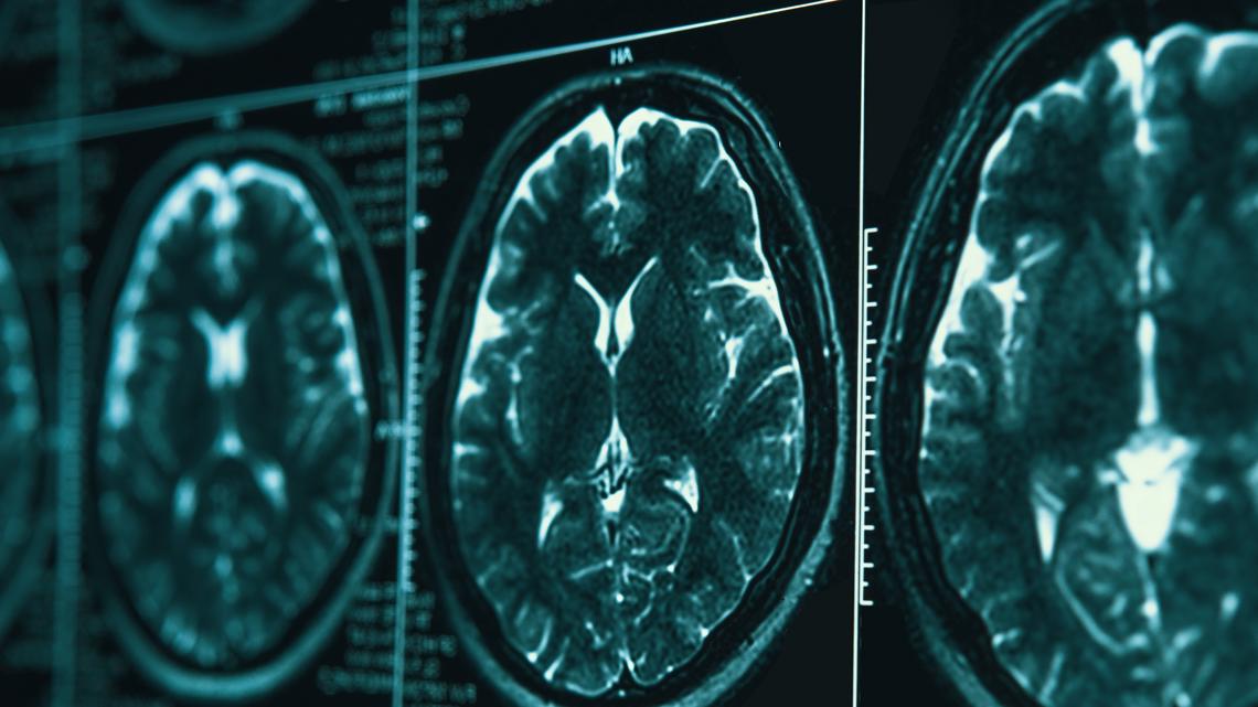 Revolucionario estudio muestra que Alzheimer pudiera se reversible en etapa avanzada