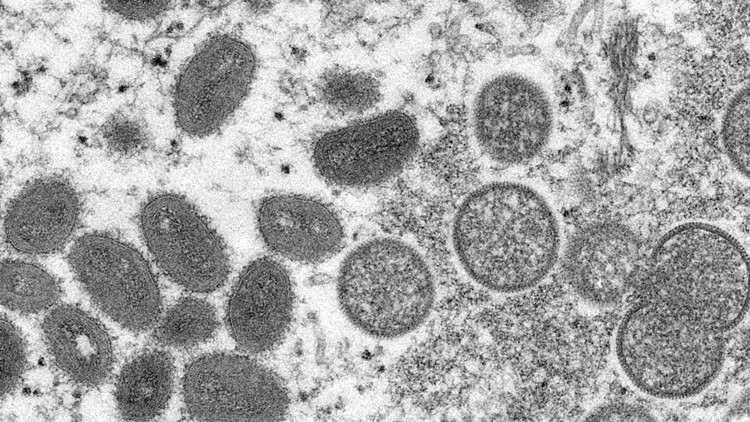 First monkeypox case confirmed in Arkansas